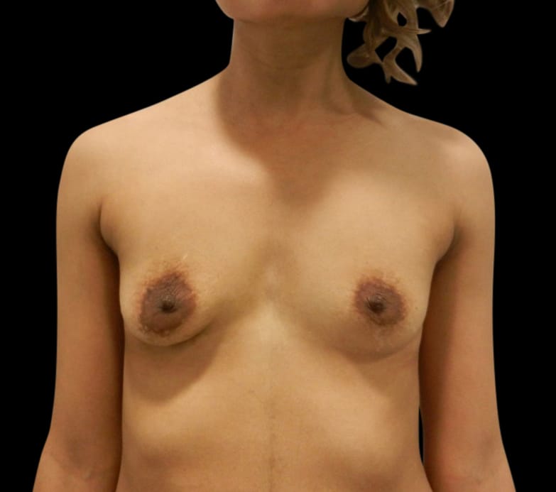 Breast Augmentation Before & After Gallery - Patient 58232663 - Image 1