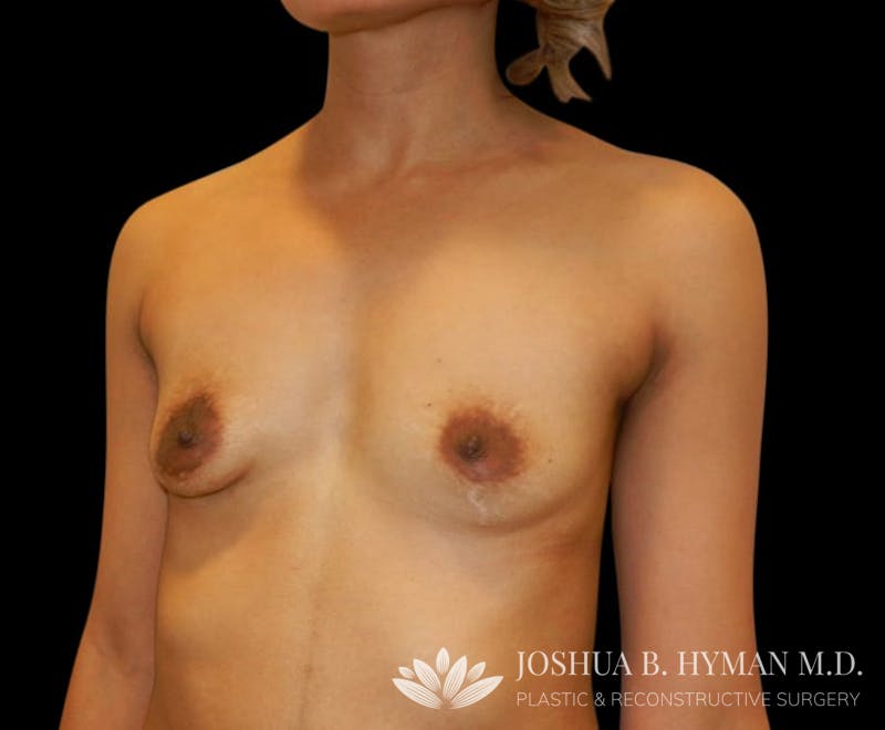 Breast Augmentation Before & After Gallery - Patient 58232663 - Image 3