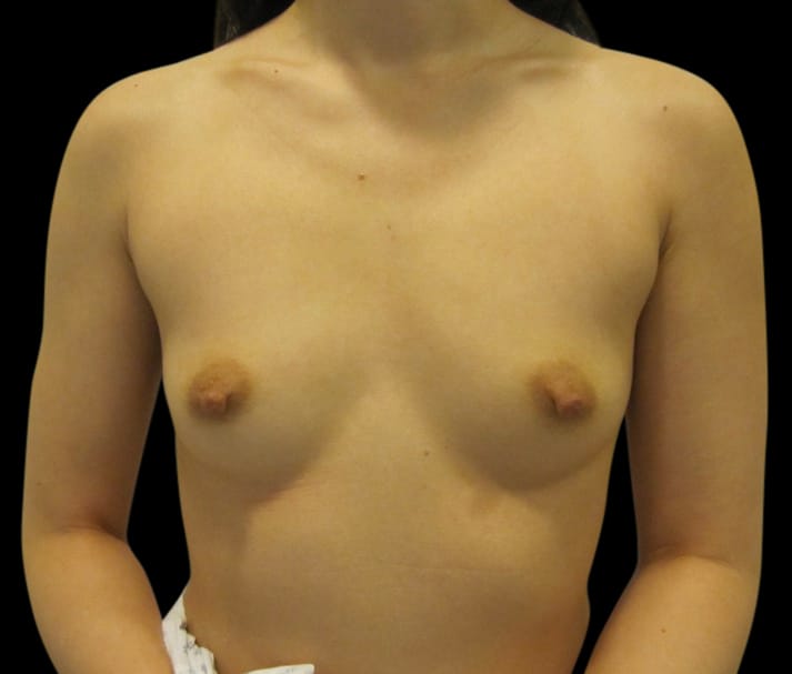 Breast Augmentation Before & After Gallery - Patient 58232699 - Image 1