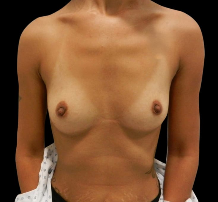 Breast Augmentation Before & After Gallery - Patient 58232744 - Image 1