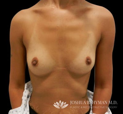 Breast Augmentation Before & After Gallery - Patient 58232744 - Image 1