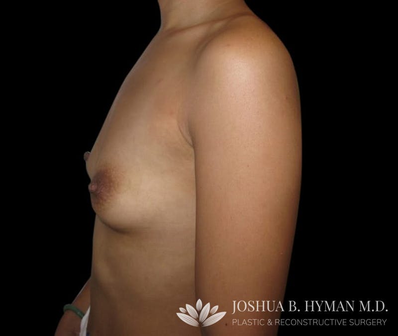 Breast Augmentation Before & After Gallery - Patient 58232745 - Image 3