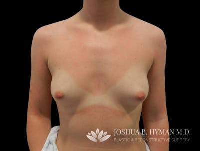 Breast Augmentation Before & After Gallery - Patient 58232747 - Image 1