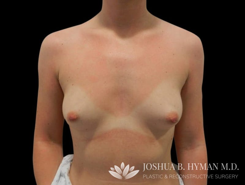 Breast Augmentation Before & After Gallery - Patient 58232747 - Image 1
