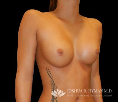Breast Augmentation Before & After Gallery - Patient 58232748 - Image 1