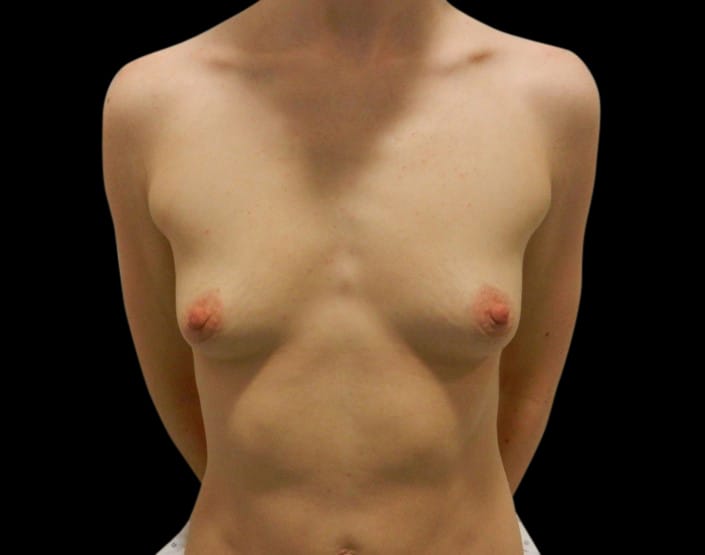 Breast Augmentation Before & After Gallery - Patient 58232749 - Image 1