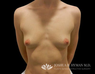 Breast Augmentation Before & After Gallery - Patient 58232749 - Image 1