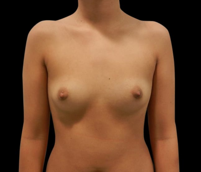Breast Augmentation Before & After Gallery - Patient 58232750 - Image 1