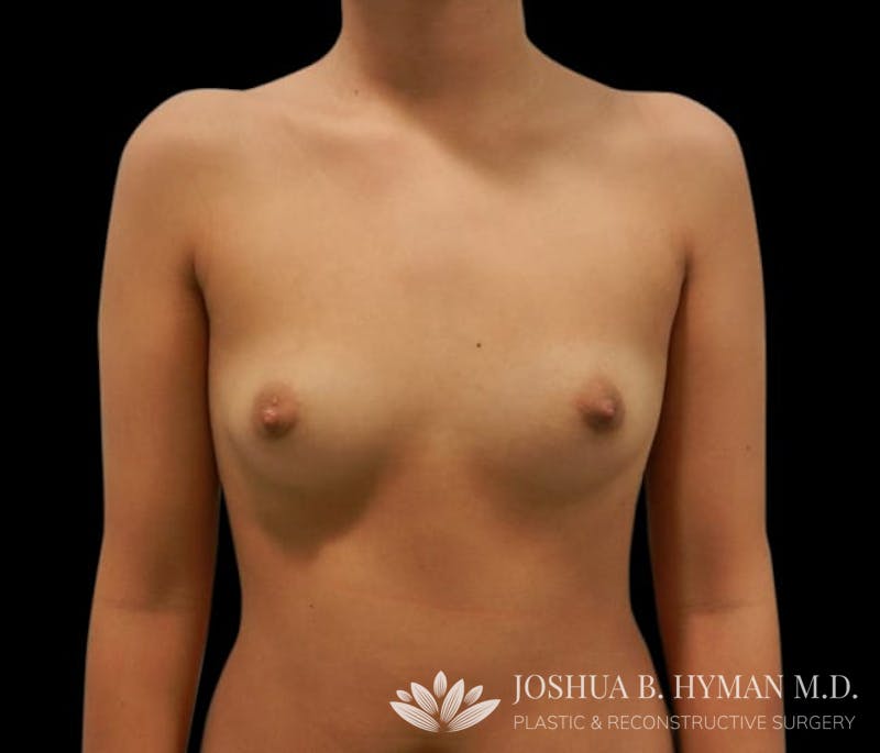 Breast Augmentation Before & After Gallery - Patient 58232750 - Image 1