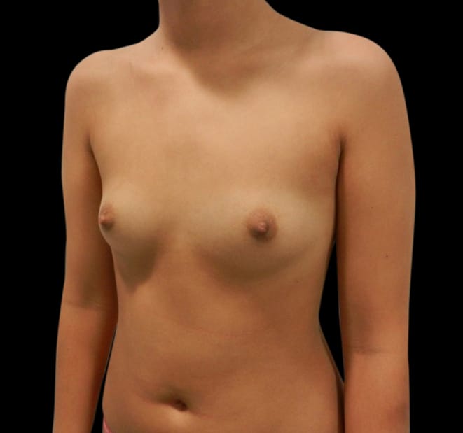 Breast Augmentation Before & After Gallery - Patient 58232750 - Image 3
