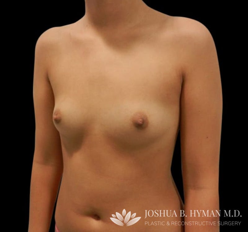 Breast Augmentation Before & After Gallery - Patient 58232750 - Image 3