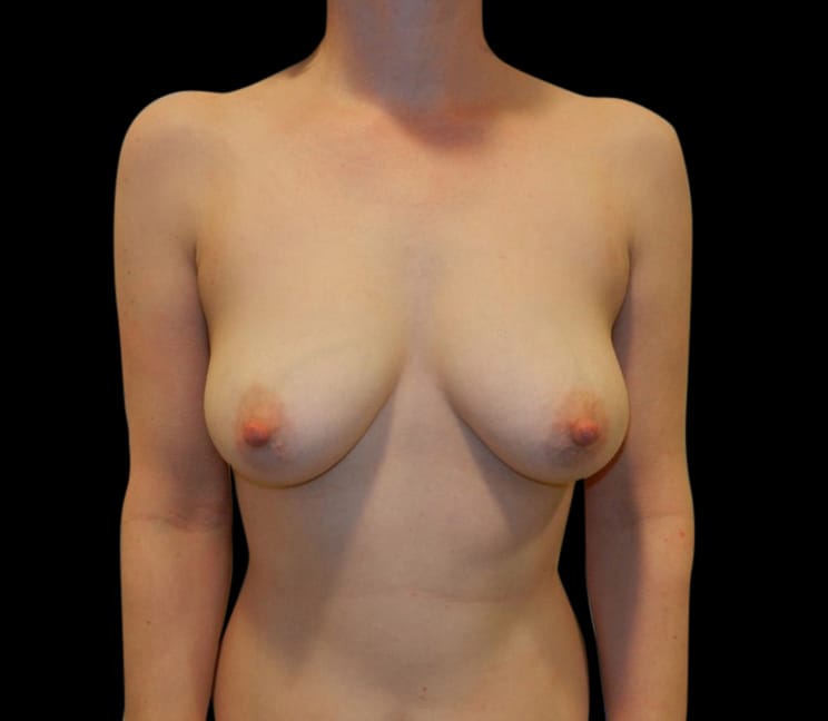 Breast Augmentation Before & After Gallery - Patient 58232752 - Image 1