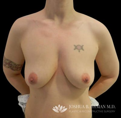 Breast Augmentation Before & After Gallery - Patient 58232753 - Image 1