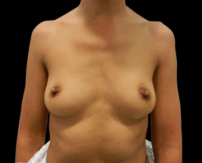 Breast Augmentation Before & After Gallery - Patient 58232755 - Image 1
