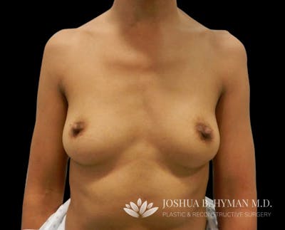 Breast Augmentation Before & After Gallery - Patient 58232755 - Image 1