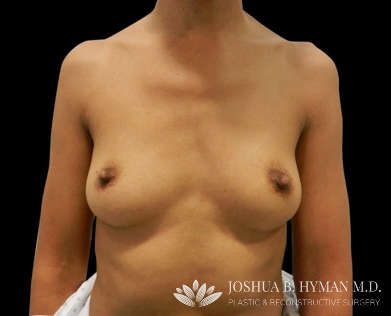 Breast Augmentation Before & After Gallery - Patient 58232755 - Image 1