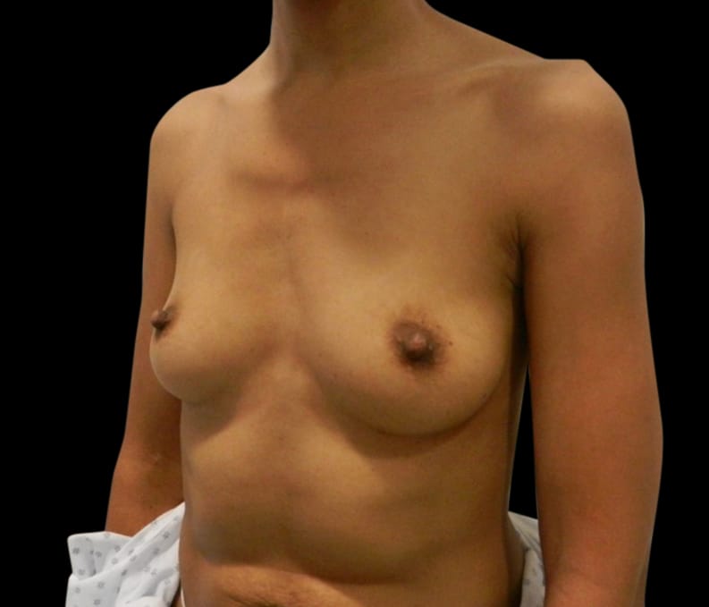 Breast Augmentation Before & After Gallery - Patient 58232755 - Image 3