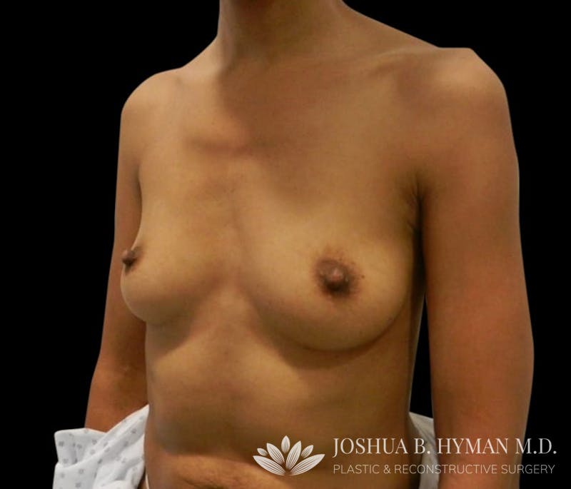 Breast Augmentation Before & After Gallery - Patient 58232755 - Image 3