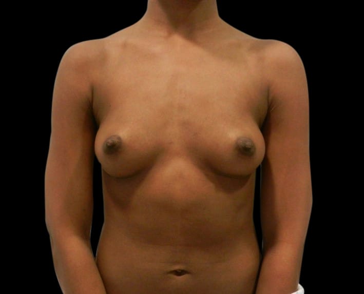 Breast Augmentation Before & After Gallery - Patient 58232756 - Image 1