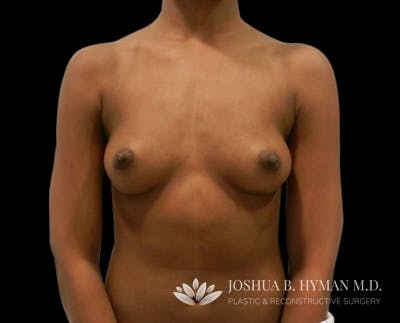 Breast Augmentation Before & After Gallery - Patient 58232756 - Image 1