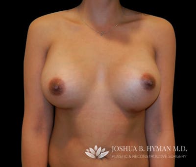 Breast Augmentation Before & After Gallery - Patient 58232757 - Image 2