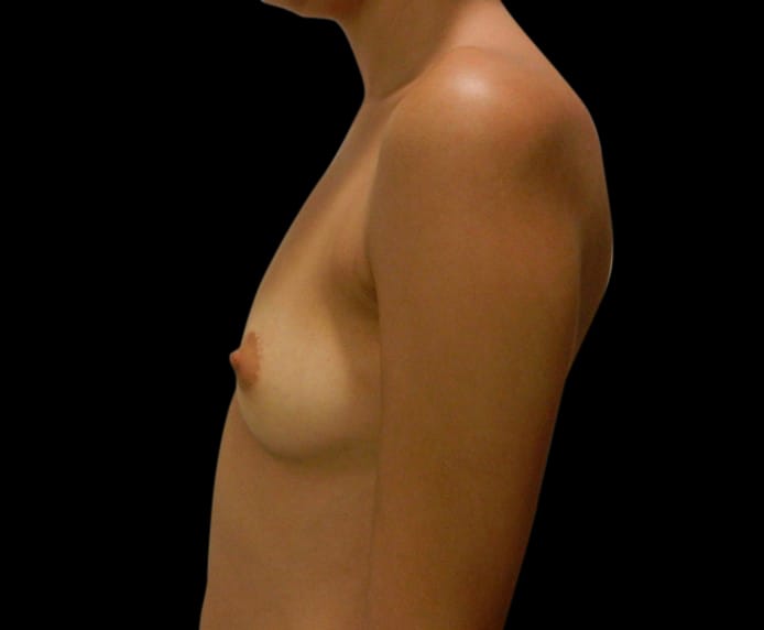 Breast Augmentation Before & After Gallery - Patient 58232758 - Image 3