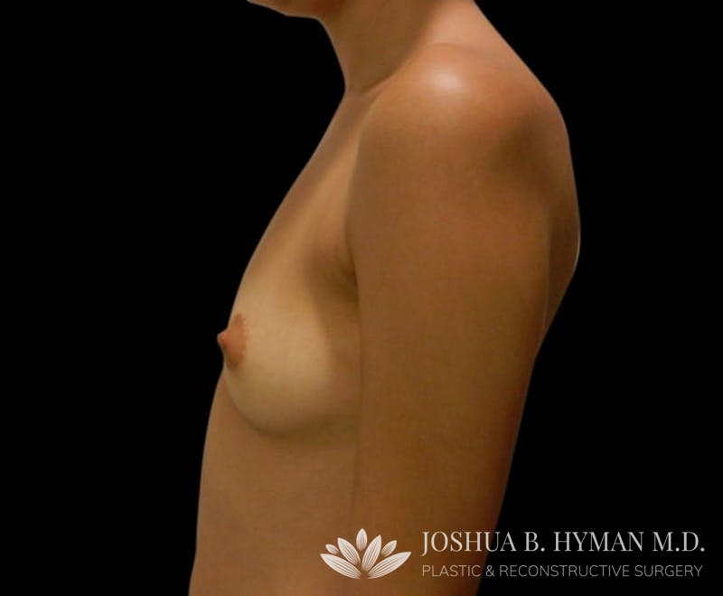 Breast Augmentation Before & After Gallery - Patient 58232758 - Image 3