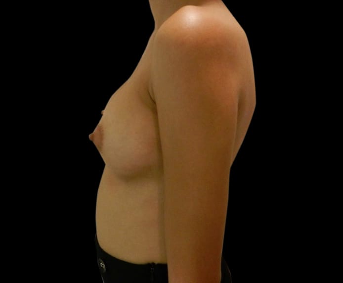 Breast Augmentation Before & After Gallery - Patient 58232758 - Image 4