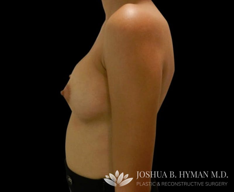 Breast Augmentation Before & After Gallery - Patient 58232758 - Image 4