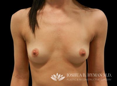 Breast Augmentation Before & After Gallery - Patient 58232759 - Image 1