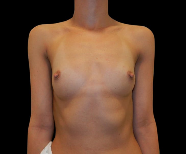 Breast Augmentation Before & After Gallery - Patient 58232760 - Image 1