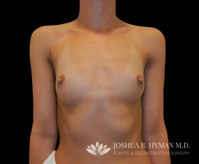 Breast Augmentation Before & After Gallery - Patient 58232760 - Image 1
