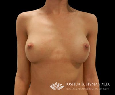 Breast Augmentation Before & After Gallery - Patient 58232760 - Image 2