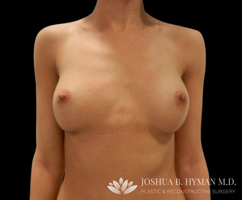 Breast Augmentation Before & After Gallery - Patient 58232760 - Image 2