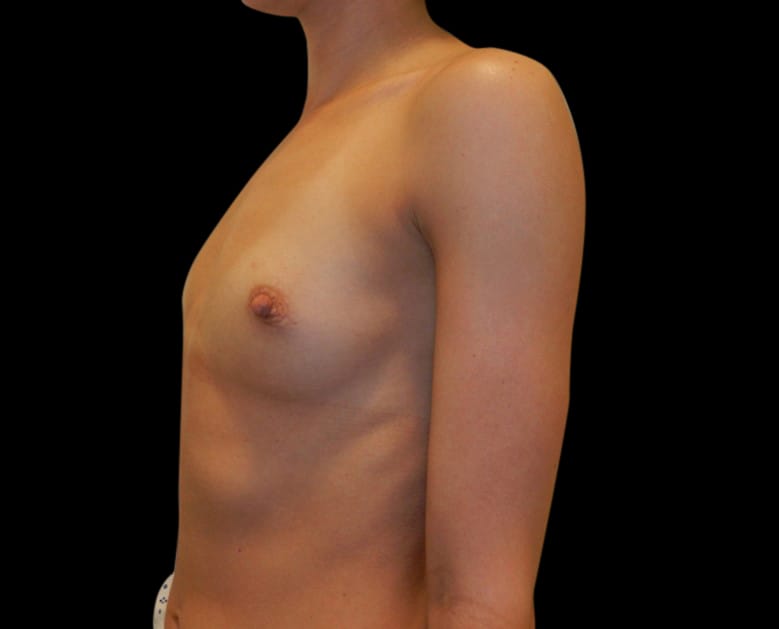 Breast Augmentation Before & After Gallery - Patient 58232760 - Image 3