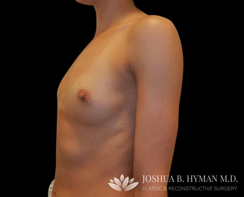 Breast Augmentation Before & After Gallery - Patient 58232760 - Image 3