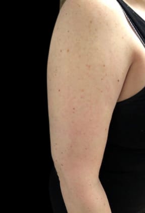 Liposuction Before & After Gallery - Patient 58232350 - Image 2