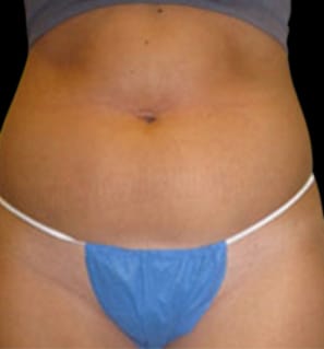 Liposuction Before & After Gallery - Patient 58232369 - Image 1