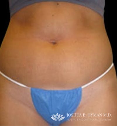 Liposuction Before & After Gallery - Patient 58232369 - Image 1