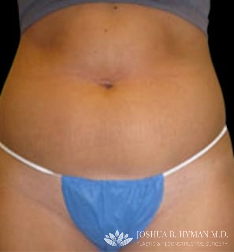 Liposuction Before & After Gallery - Patient 58232369 - Image 1