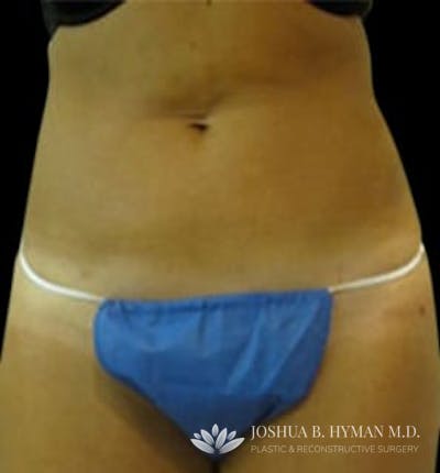 Liposuction Before & After Gallery - Patient 58232369 - Image 2