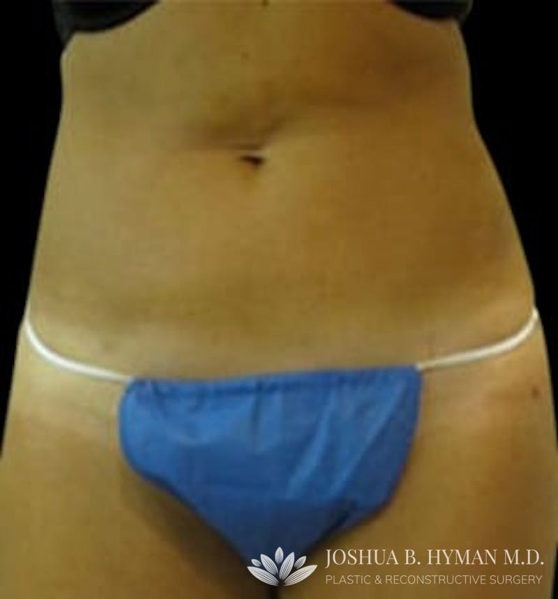 Liposuction Before & After Gallery - Patient 58232369 - Image 2