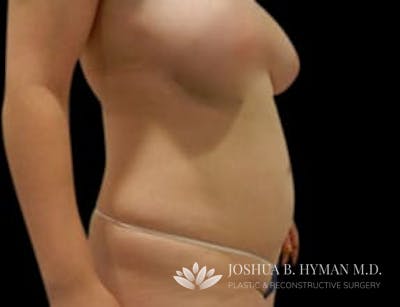 Liposuction Before & After Gallery - Patient 58232384 - Image 1