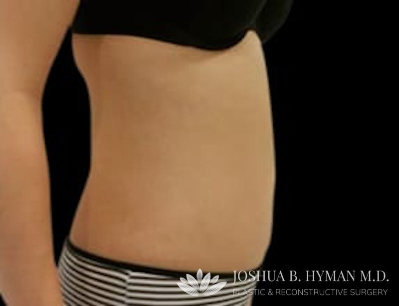 Liposuction Before & After Gallery - Patient 58232384 - Image 2