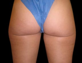 Liposuction Before & After Gallery - Patient 58232387 - Image 1
