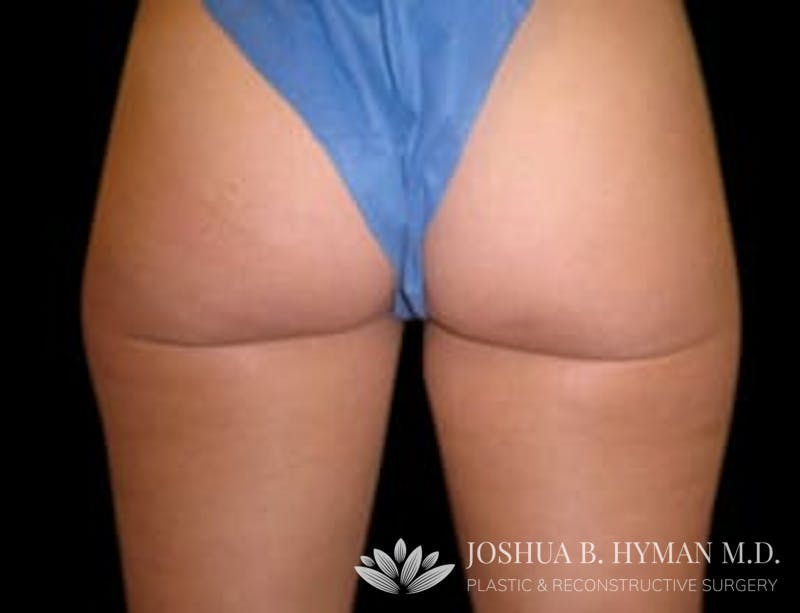 Liposuction Before & After Gallery - Patient 58232387 - Image 1