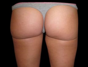Liposuction Before & After Gallery - Patient 58232387 - Image 2