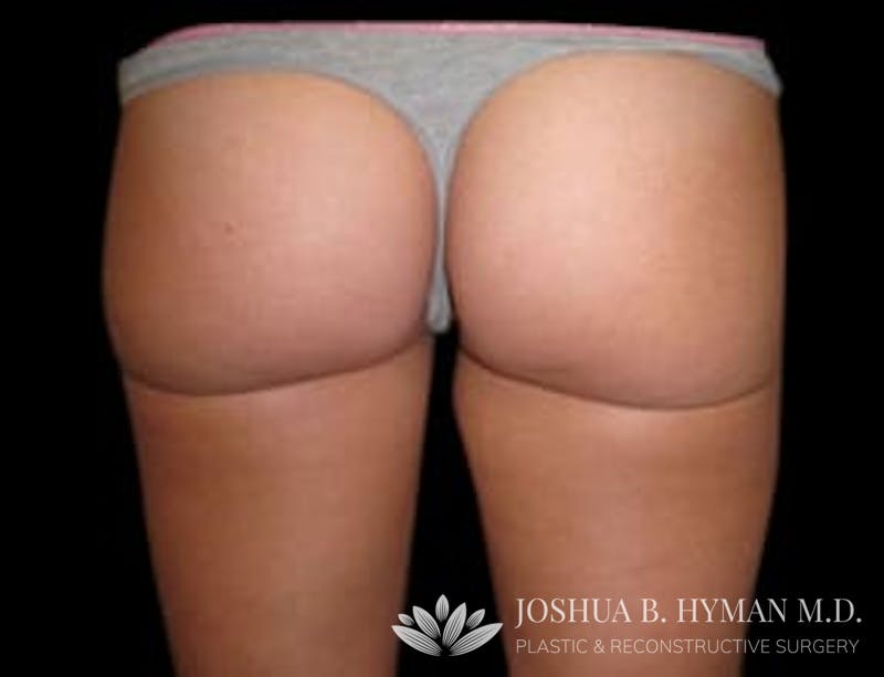 Liposuction Before & After Gallery - Patient 58232387 - Image 2