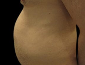 Liposuction Before & After Gallery - Patient 58232392 - Image 1