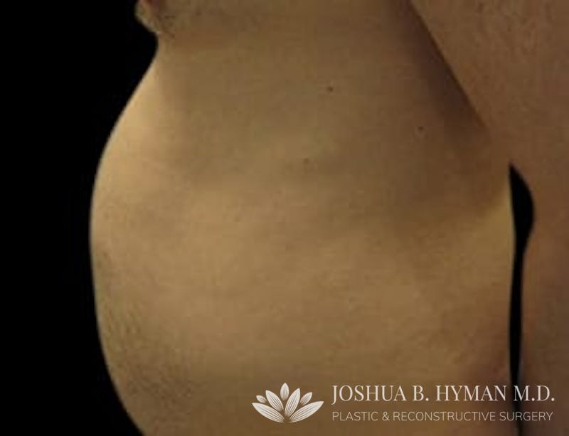 Liposuction Before & After Gallery - Patient 58232392 - Image 1